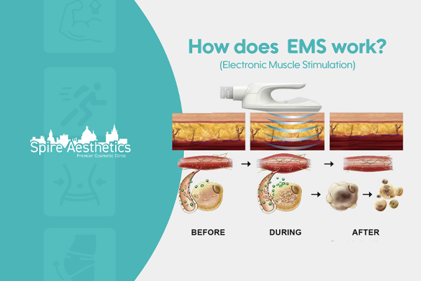 EMS treatment for post pregnancy weight loss treatment Dorking