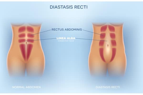 What Non-Surgical Options Are Available for Diastasis Recti Dorking?