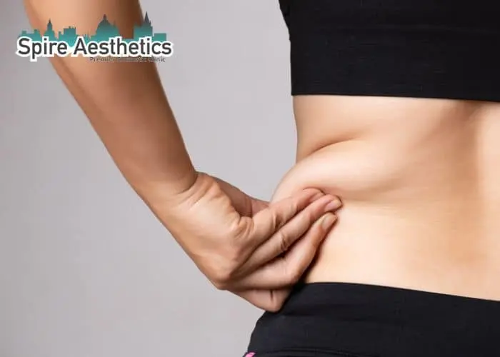 Image of woman pinching fat on their hips Dorking. Fat Freezing treatment