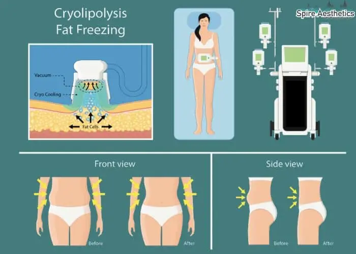Fat freezing treatment Dorking benefits for competitions to remove stubborn fat deposits.