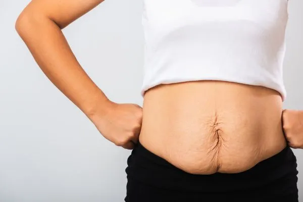 Image of a woman's stomach after weight loss with sagging skin following a gastric band Dorking