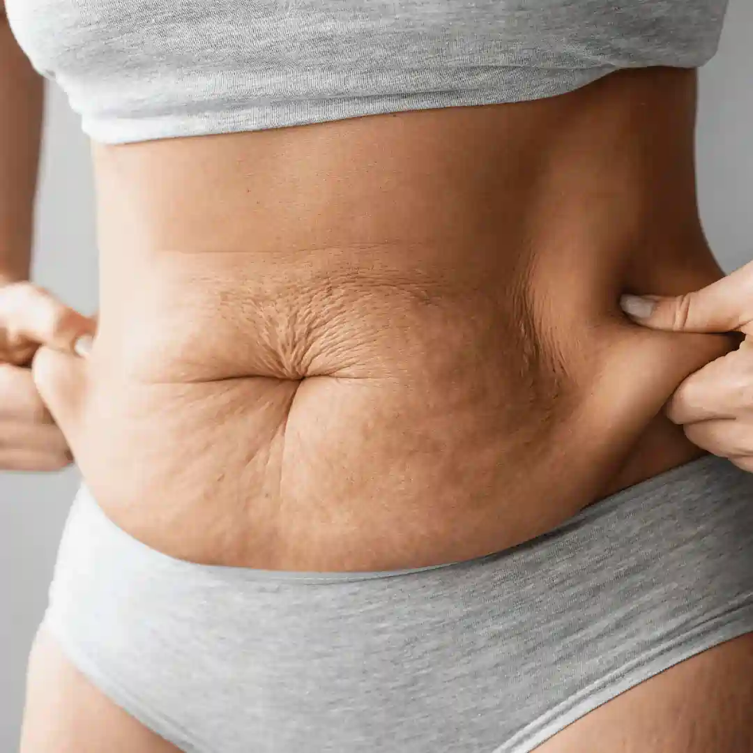 Is It Normal to Have Loose Skin After Pregnancy Dorking?
