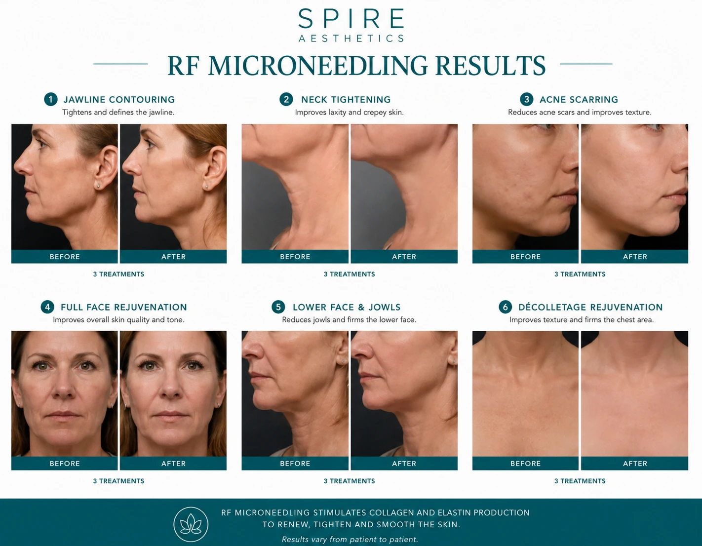 RF Microneedling Skin tightening Dorking results