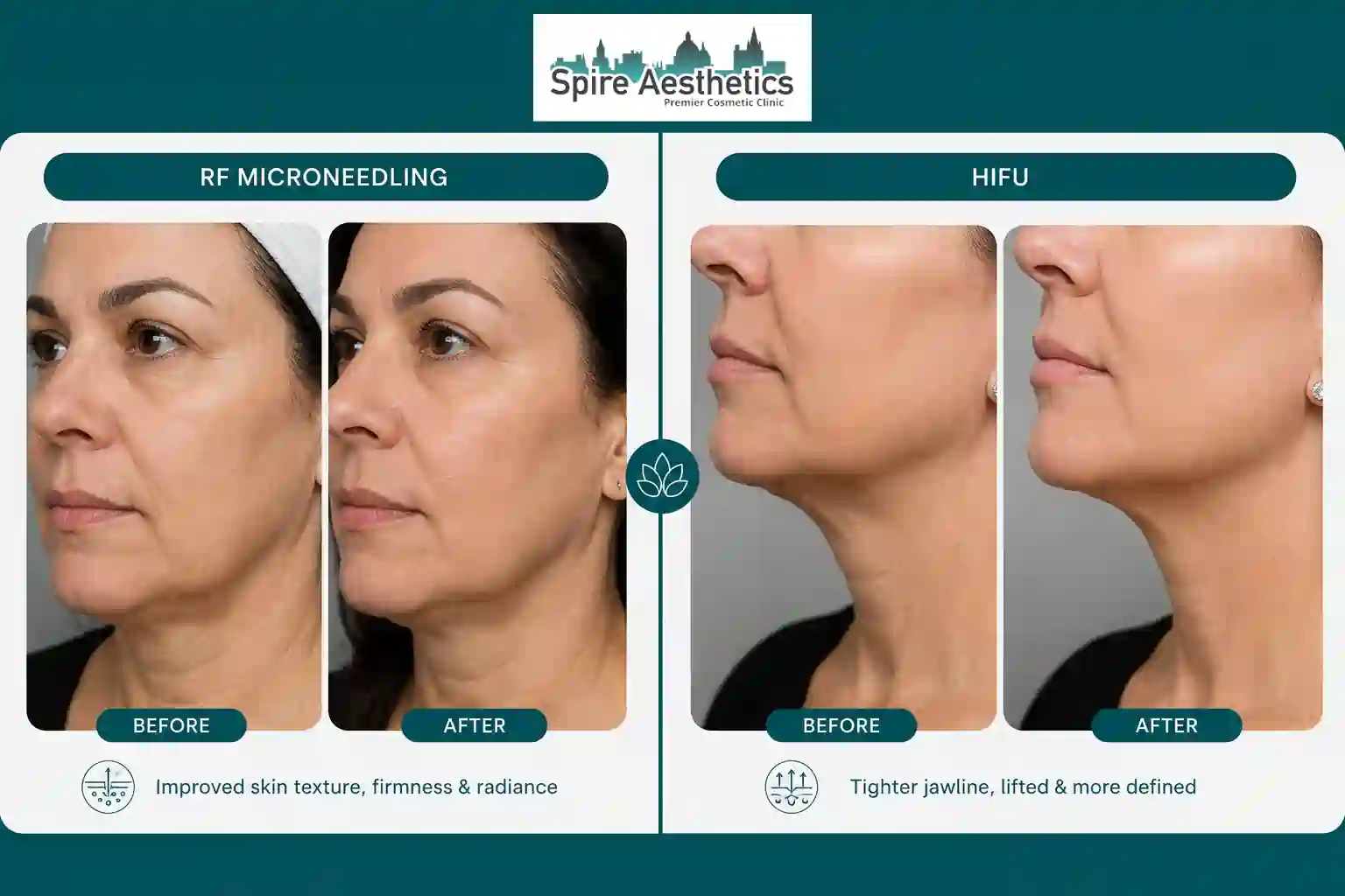 Can RF Microneedling and HIFU Be Combined Dorking?