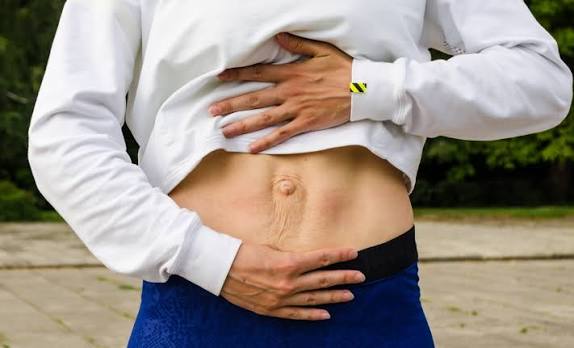 When Could Diastasis Recti Be the Missing Piece of the Puzzle Dorking?