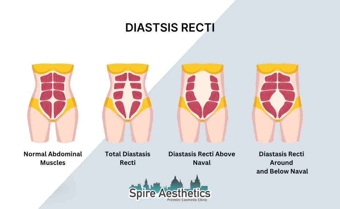 Is Non-Surgical Diastasis Recti Treatment Right for You? Common Concerns Answered Dorking
